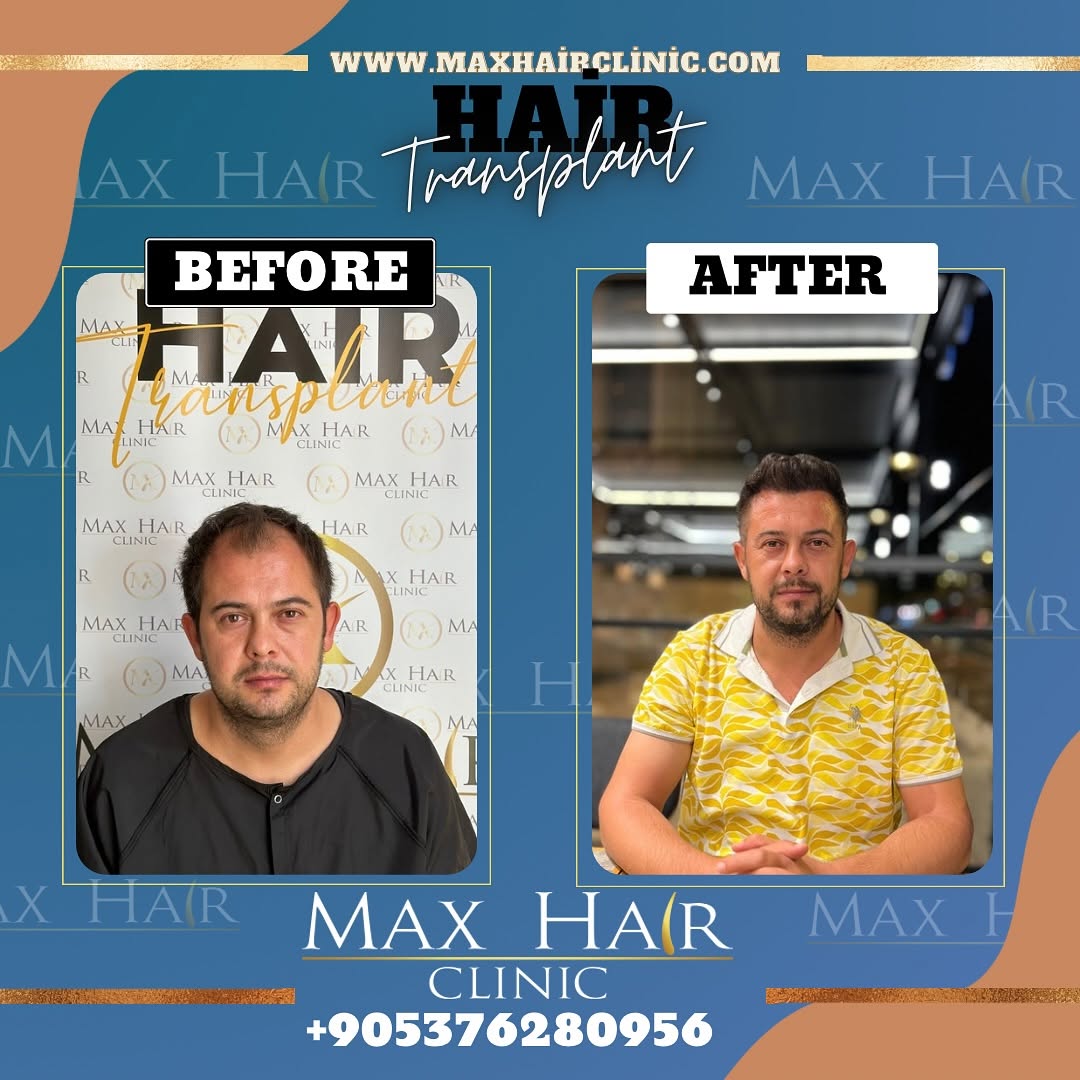 maxhairclinic_beforearfter-img1